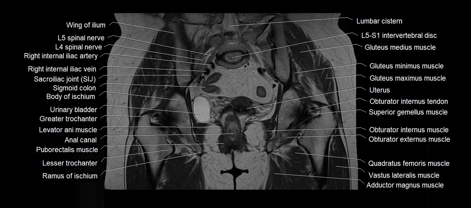 MRI 3T pelvis coronal cross section anatomy image 16.webp